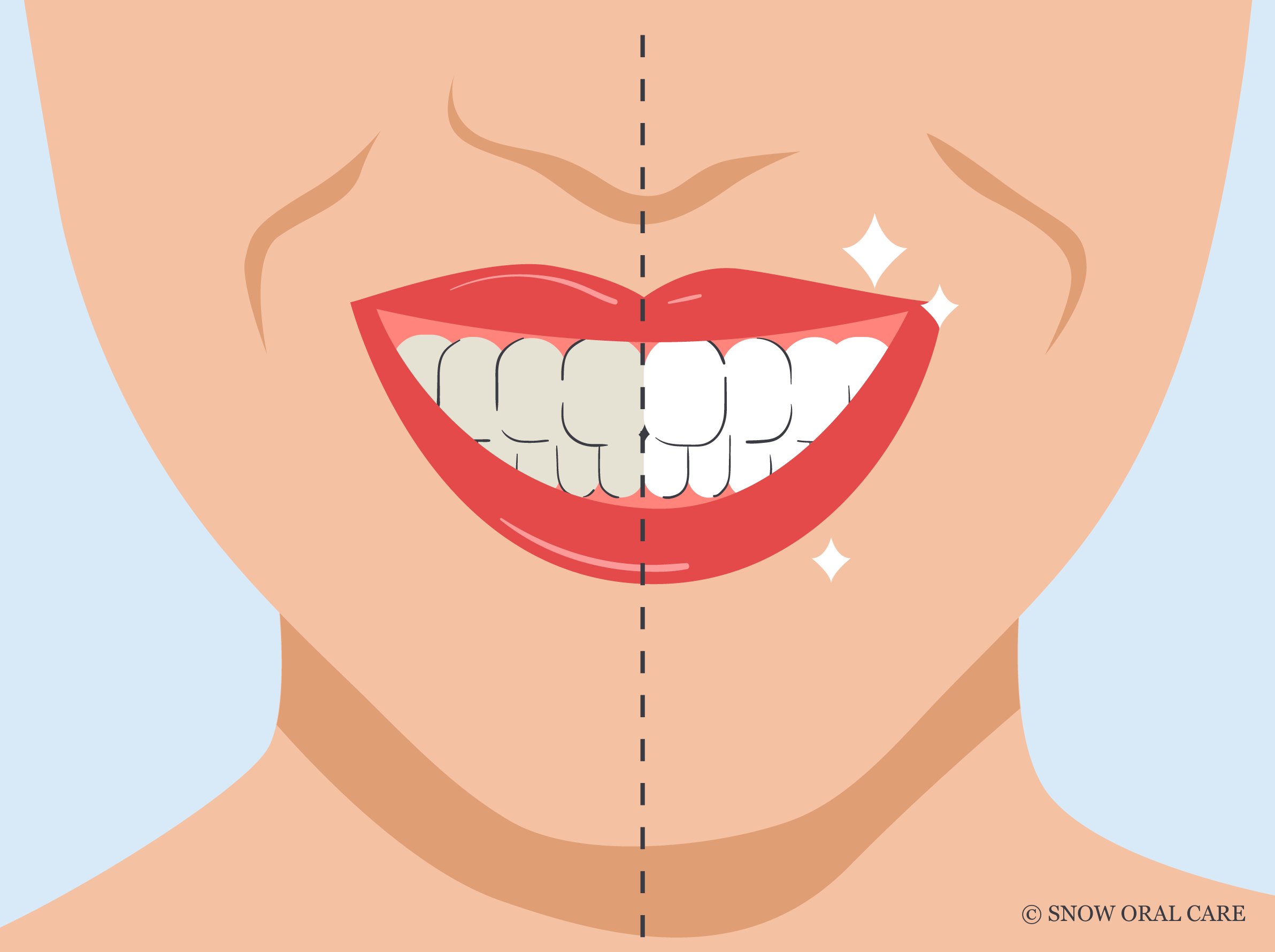 How to Remove Stains from Bonded Teeth at Home (Guide & Tips)