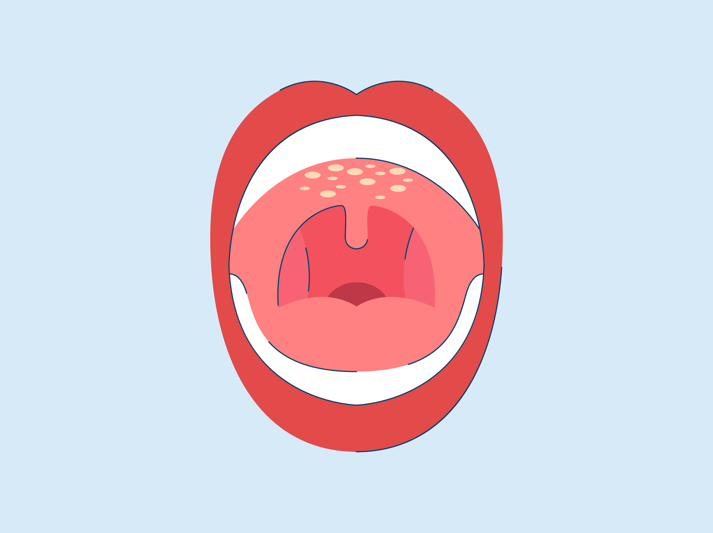 Roof of Mouth Hurts? Here's What May Be Causing it and Treatments