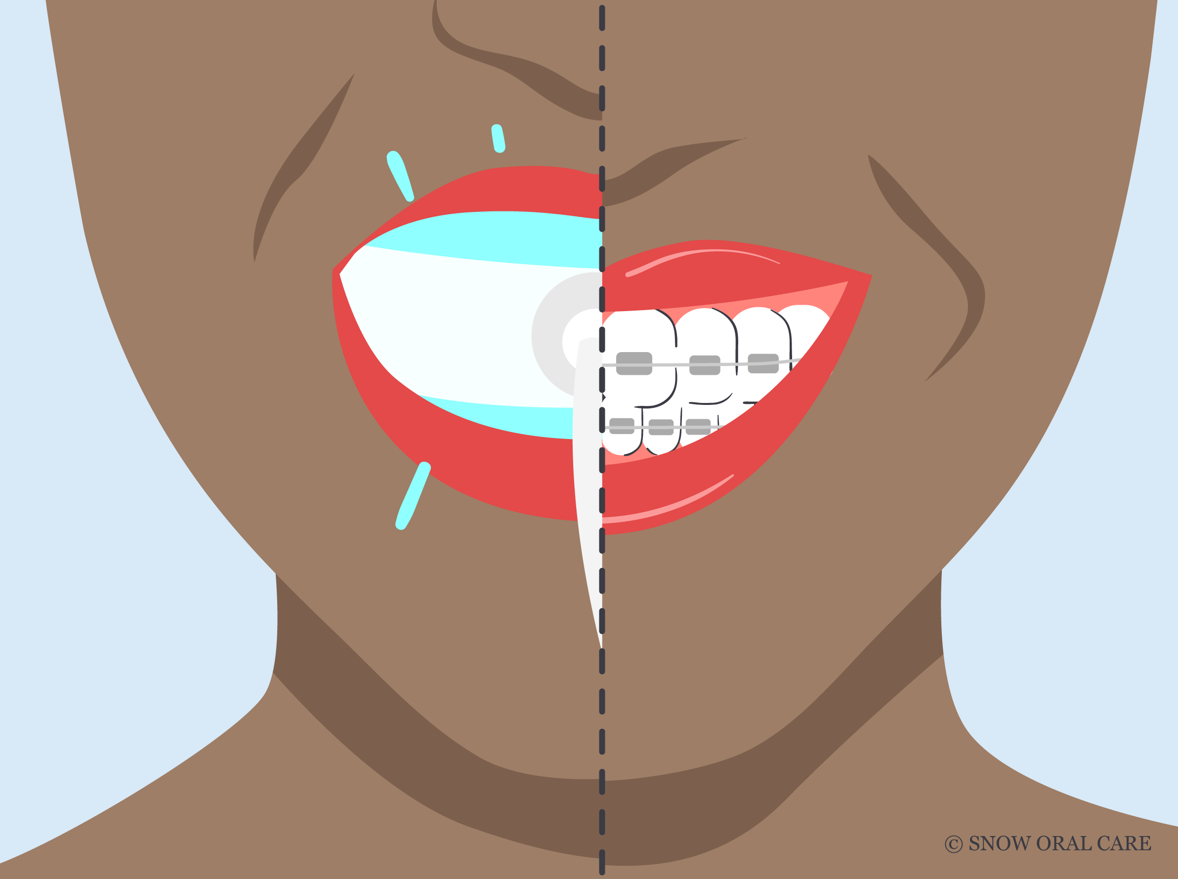 Should I Whiten My Teeth Before Braces? SNOW® Oral Care