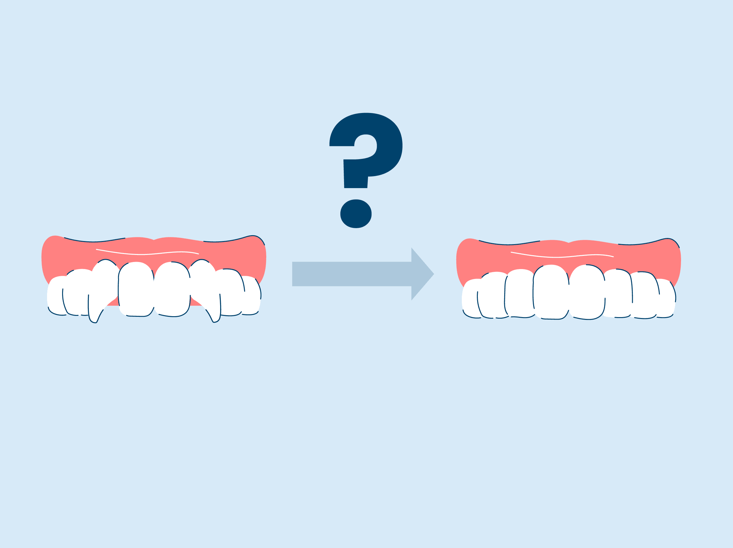 Snarly Teeth How to Fix a Snaggle Tooth – SNOW® Oral Care