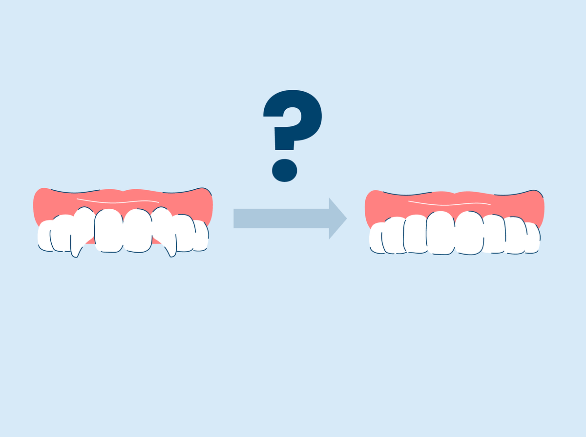 Snarly Teeth How to Fix a Snaggle Tooth – SNOW® Oral Care