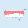 gingivectomy