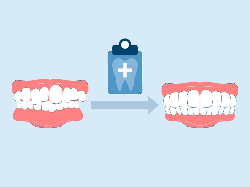 9 Ways to Get Crooked Teeth Fixed With Braces or Cosmetic Dentistry