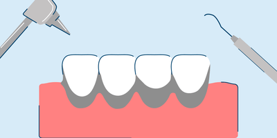 Black Tartar on Teeth: Causes, Symptoms, and Treatment