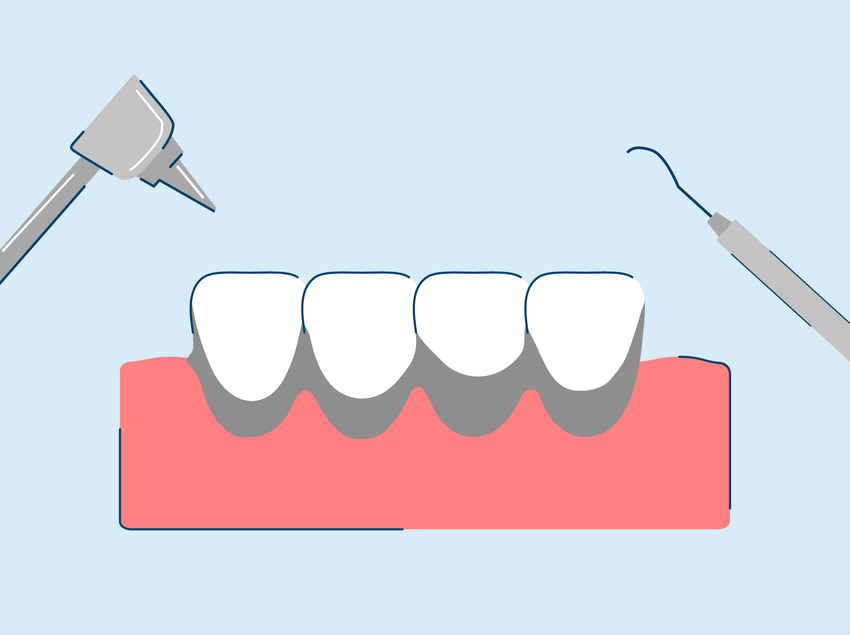 Black Tartar on Teeth: Causes, Symptoms, and Treatment