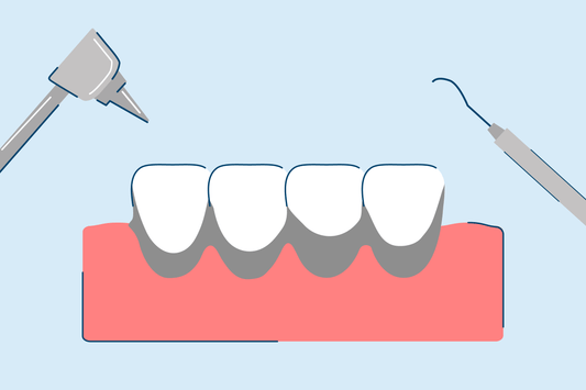 Black Tartar on Teeth: Causes, Symptoms, and Treatment