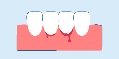 Bleeding Gums: Causes, Prevention, and Treatments