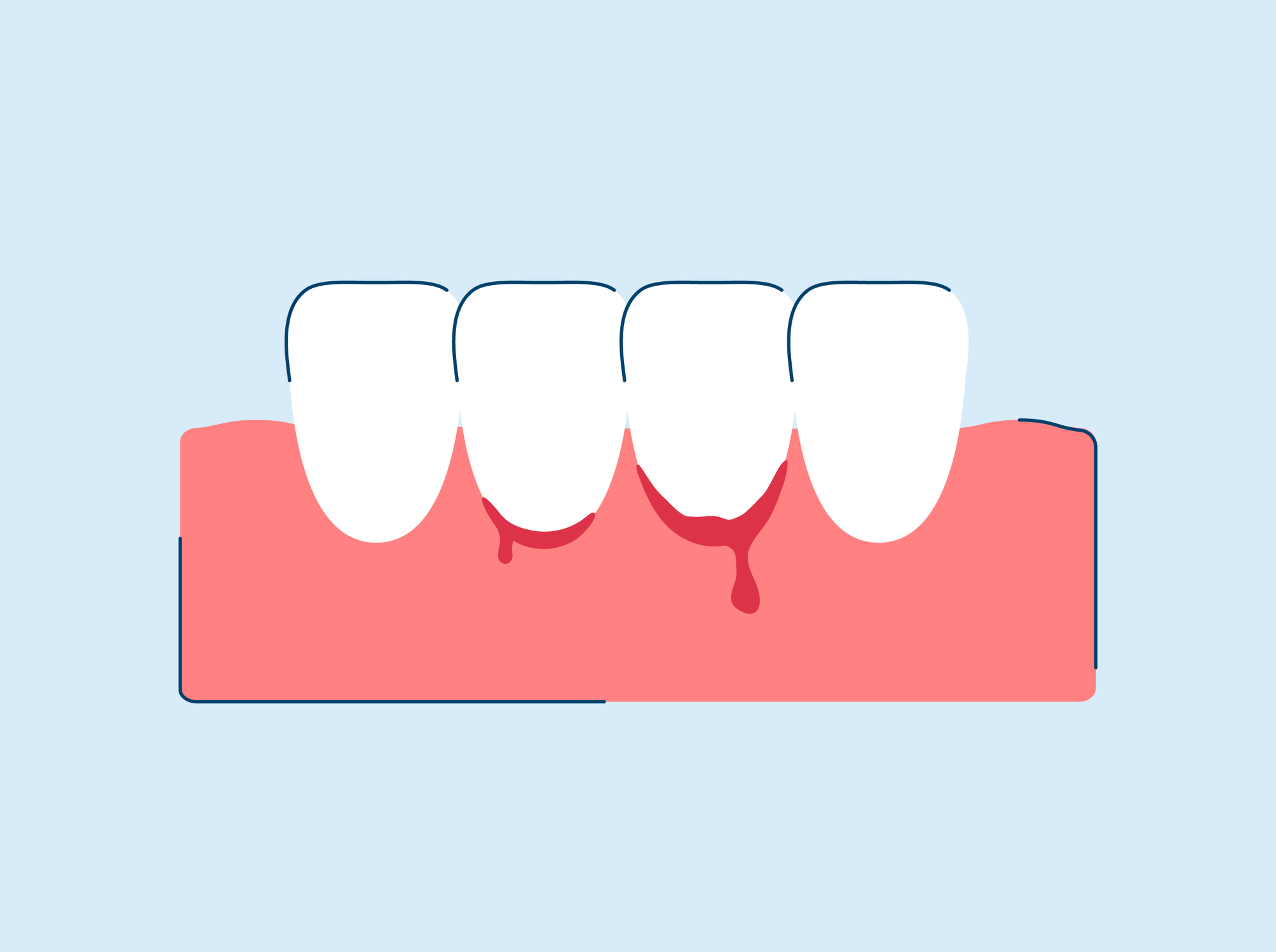 Bleeding Gums: Causes, Prevention, and Treatments