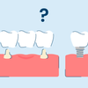 Bridge vs. Implant: What's The Difference?