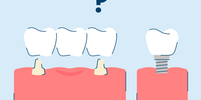 Bridge vs. Implant: What's The Difference?