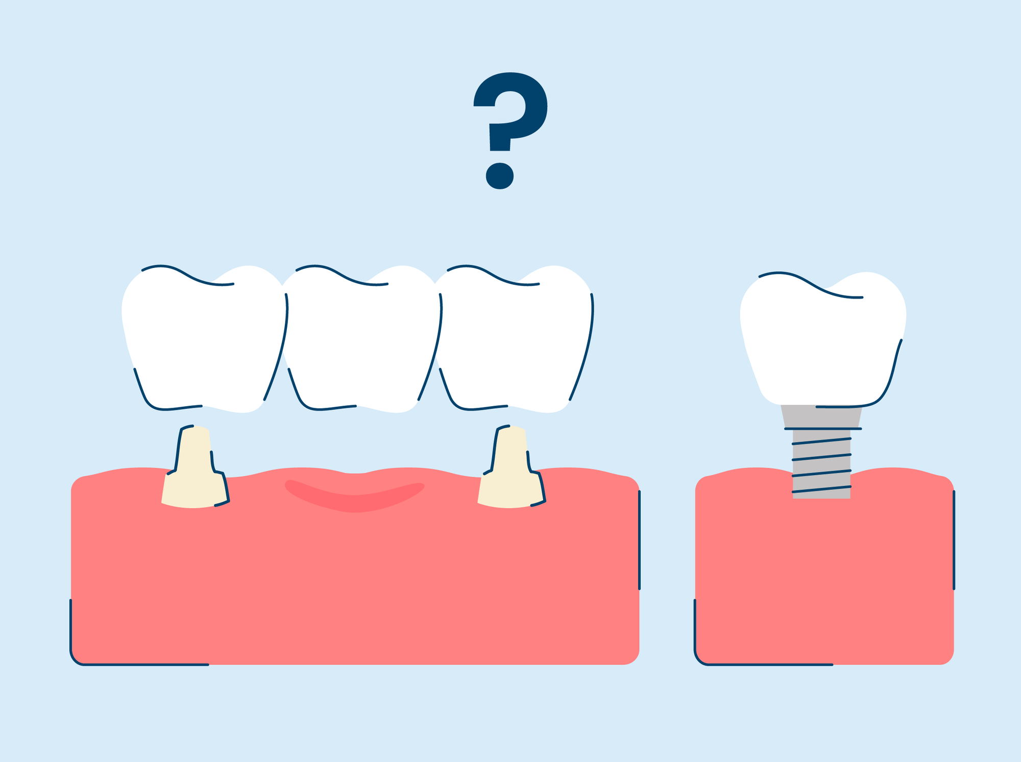 Bridge vs. Implant: What's The Difference?