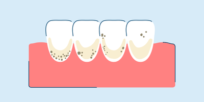 Brown Stains on Teeth: Prevention, Causes, and Treatment