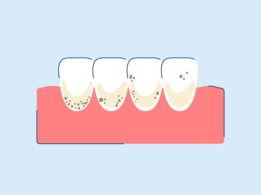 Brown Stains on Teeth: Prevention, Causes, and Treatment