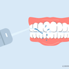 can i use a water flosser after wisdom teeth removal 