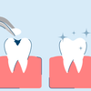 Cavity Filling 101: What to Expect, Procedure, and Costs
