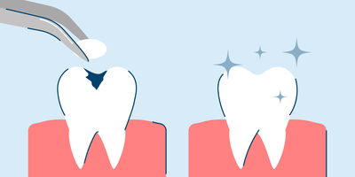 Cavity Filling 101: What to Expect, Procedure, and Costs