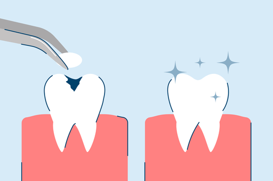 Cavity Filling 101: What to Expect, Procedure, and Costs