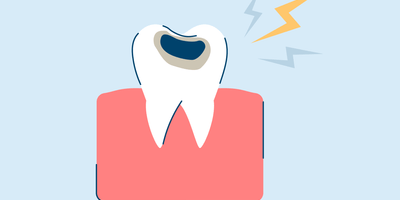an illustration of a tooth with a cavity