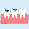 Cavity and Tooth Decay: Symptoms and Causes