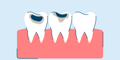 Cavity and Tooth Decay: Symptoms and Causes