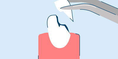 Chipped Tooth Causes and Repair