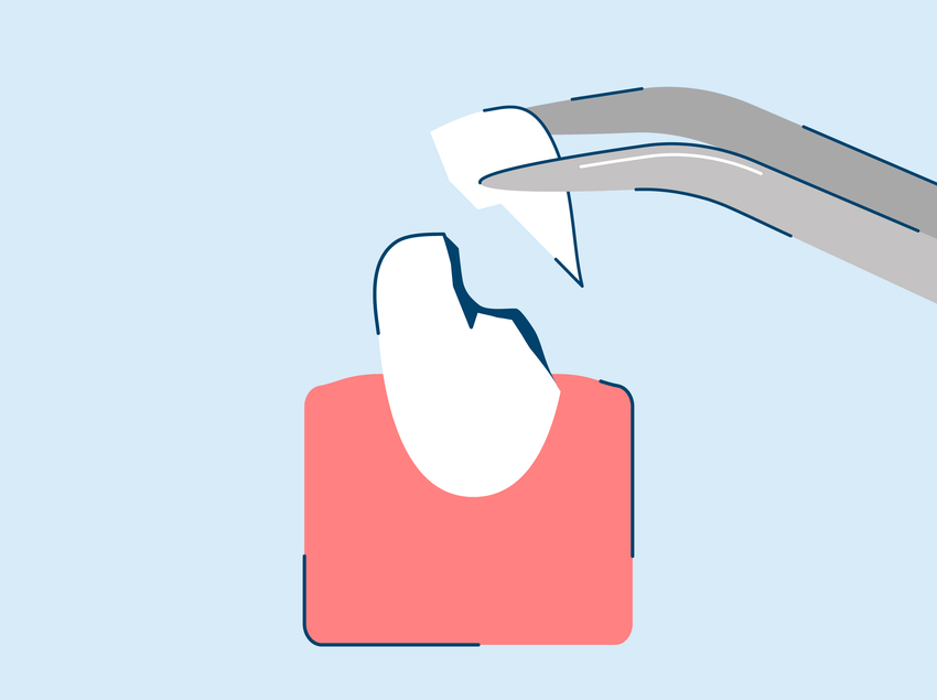 Chipped Tooth Causes and Repair