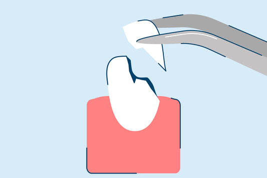 Chipped Tooth Causes and Repair