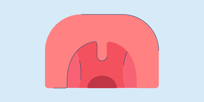 Cobblestone Throat: Causes and Treatment