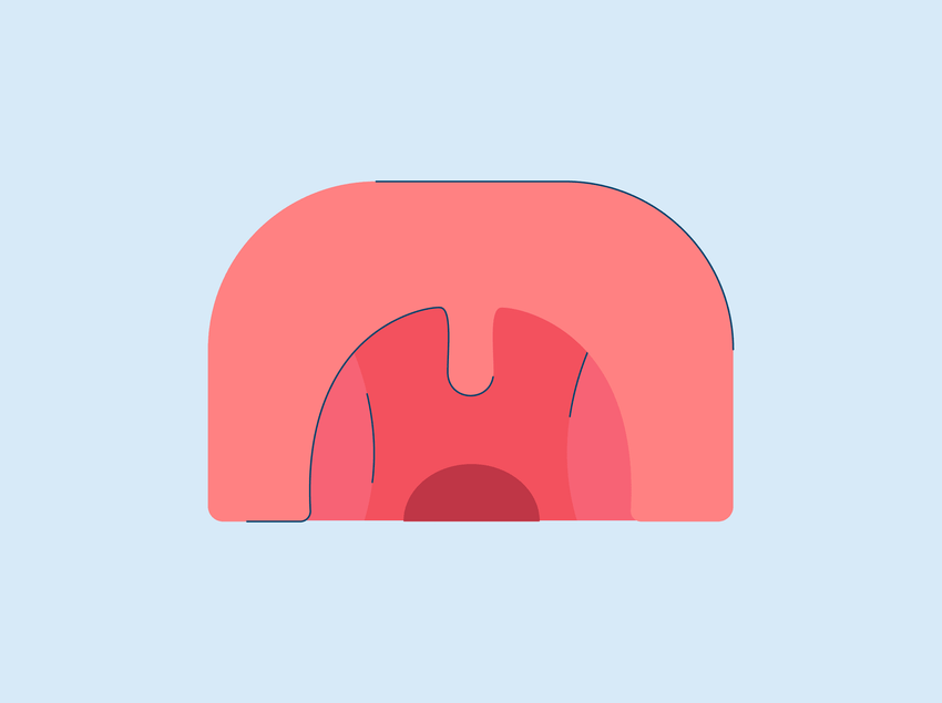 Cobblestone Throat: Causes and Treatment