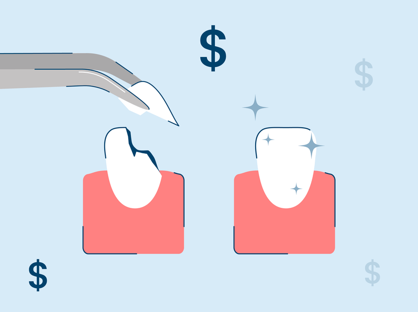 How Much Does It Cost to Fix a Chipped Tooth?
