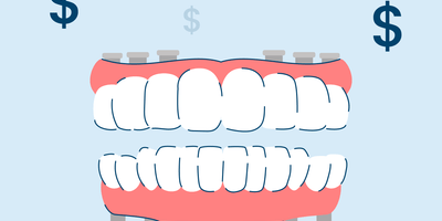 How Much Do Full Mouth Dental Implants Cost?