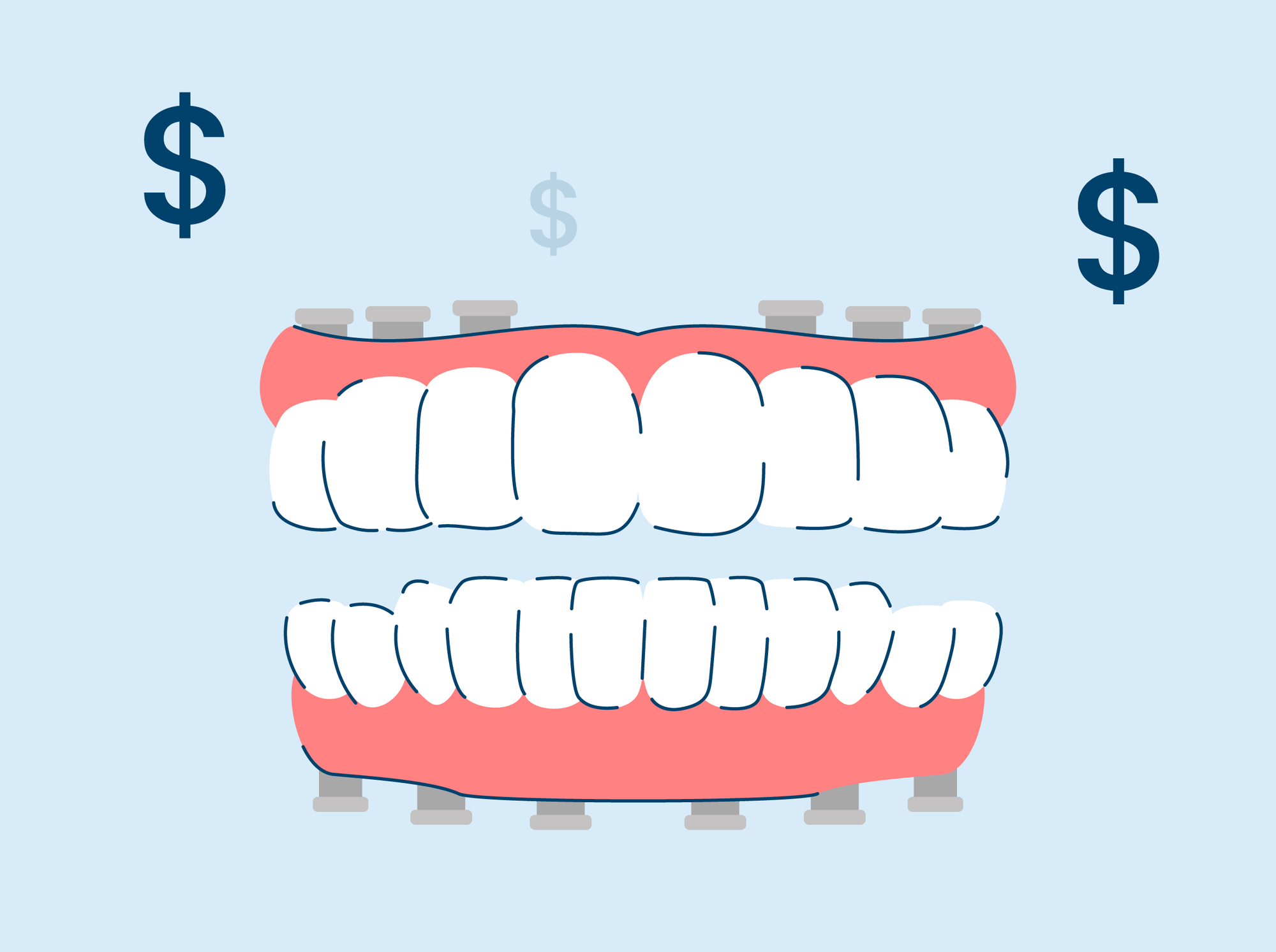 How Much Do Full Mouth Dental Implants Cost?