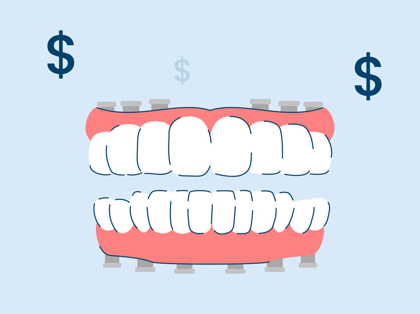 How Much Do Full Mouth Dental Implants Cost?