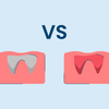 Dry Socket vs. Normal Socket After Tooth Extraction