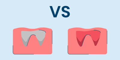Dry Socket vs. Normal Socket After Tooth Extraction
