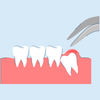emergency wisdom tooth removal process - everything you need to know