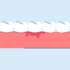 Gingivitis: Causes, Symptoms, and Treatment