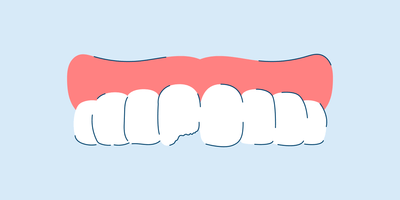 How to Fix a Chipped Tooth at Home