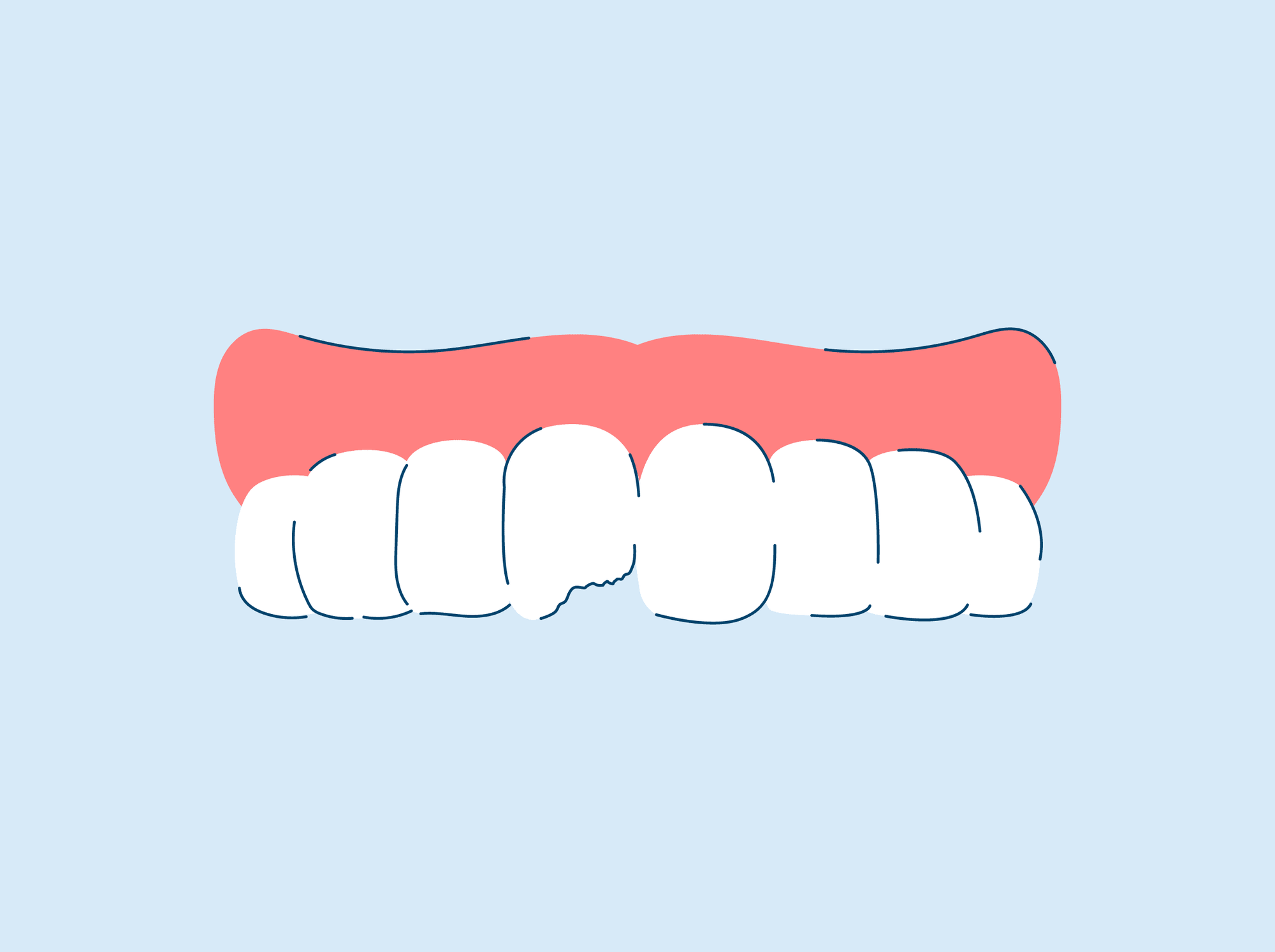 How to Fix a Chipped Tooth at Home