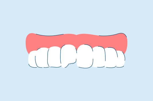 How to Fix a Chipped Tooth at Home