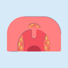 early stage white spots throat cancer