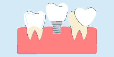 Restorative Dentistry: Procedures and Treatments