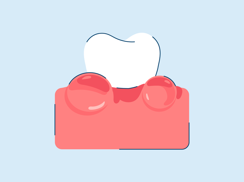 How to Treat Sore Gums
