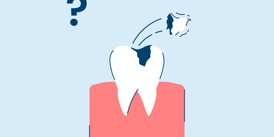 What To Do If Your Tooth Filling Fell Out