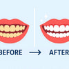 The Best Teeth Whitening Before and After Results: What to Expect