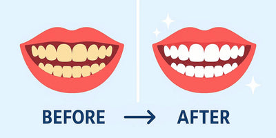 The Best Teeth Whitening Before and After Results: What to Expect