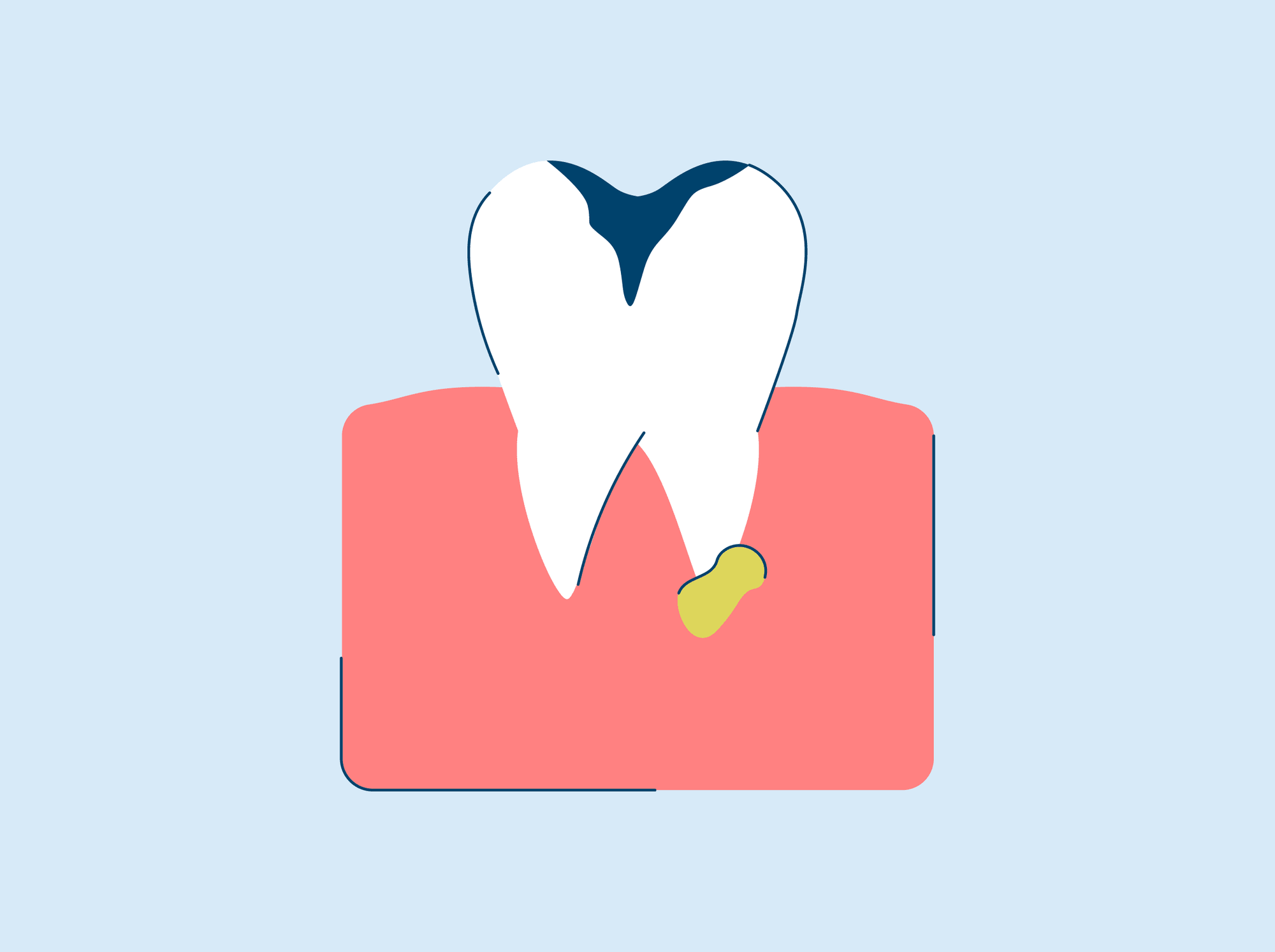 Tooth Abscess: Stages, Symptoms, and Treatment