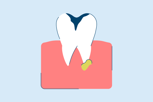 Tooth Abscess: Stages, Symptoms, and Treatment