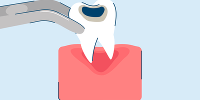 Tooth Extraction: Procedure, Aftercare, and Recovery