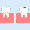 Tooth Decay: Causes, Symptoms, and Treatment
